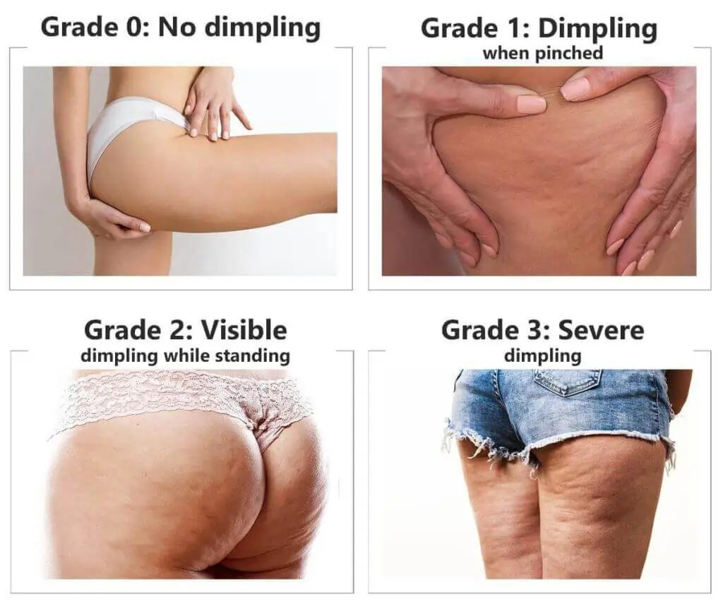 Representation of the stages of cellulite development Bradford-on-Avon